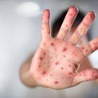 Тернопільські медики розповіли про загрозу кору