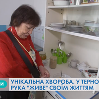 Через унікальну хворобу рука тернополянки “живе” своїм життям (Відео)