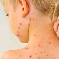 Де у Тернополі можна провакцинуватися від кору?