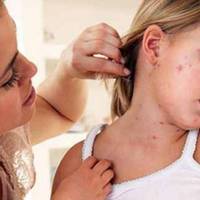 УВАГА!У Тернополі через кір обмежують масові заходи за участю дітей