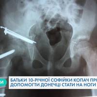 Небайдужих тернополян просять допомогти зібрати кошти на операцію маленькій Софійці Копач