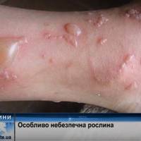 Отрута є дуже підступною, опіки з’являються не одразу: на Тернопільщині борються з небезпечною рослиною