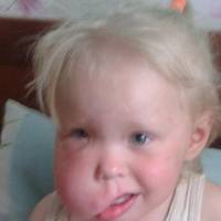 Більш як тисяча небайдужих переказали кошти для дівчинки з Тернопільщини, яку рятує лікар Валіхновський