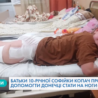 Через різницю у довжині ніг Софійці Копач потрібна ще одна - четверта - операція. ВІДЕО