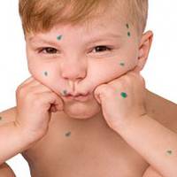 24 людей за день захворіли вітряною віспою на Тернопільщині