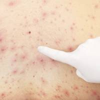 На Тернопільщині поширюється інфекція, яка вражає переважно дітей (Відео)