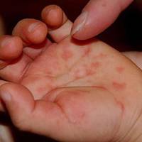 У МОЗ попередили українців про спалах вірусу Коксакі