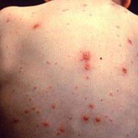 Областю шириться небезпечна для дорослих людей хвороб