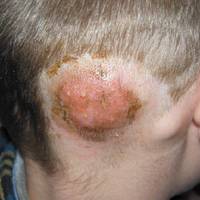 Рідкісну інфекцію «трихофітію» зафіксували лікарі у жителя Тернопільщини