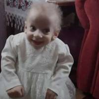 В Україні від старості померла 8-річна дівчинка (ФОТО)