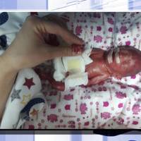 У Тернополі виходили немовля, яке народилось з вагою 610 грамів