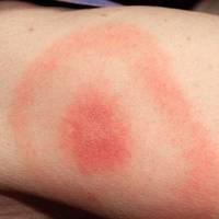 Кількість укусів збільшується: розповіли, які страшні хвороби переносять звичайні кліщі