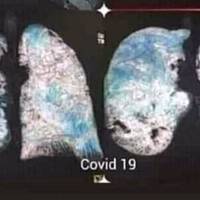 Тернопільські медики показали легені людини, яка хворіє COVID-19