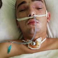 У постраждалого в ДТП Максима Беспалова з Кременця запалення мозку – потрібна допомога