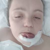 Порізане обличчя та пекельний біль: Наталя Борисюк з Теребовлі розповіла про життя сьогодні (Фото)