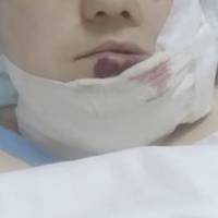 “На обличчі немає “живого” місця, воно порізане, а біль пекелний”: жінка з Тернопільщини потребує допомоги