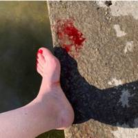 У Тернополі на ставі купатися небезпечно: хлопець порізав голову, а жінка ногу