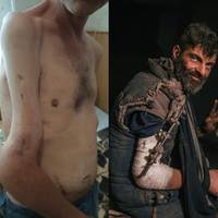 Родина звільненого з полону тернополянина Михайла Діанова припинила збір коштів на його лікування: в чому причина