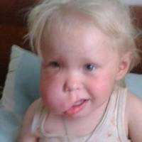 Маленьку дівчинку з Тернопільщини, яку ще ненародженою покалічив рідний батько, оперуватиме відомий на всю країну хірург