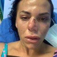 Тріщини в черепі і носі: жінка з Тернополя важко травмувалася на відпочинку за кордоном (ФОТО)