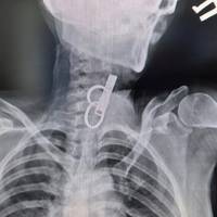 На Тернопільщині лікарі витягли зі стравоходу жінки ключ від дверей